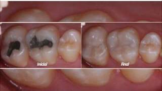 Restaurações Estéticas em Dentes Posteriores [upl. by Ylebmik914]