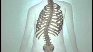 Teen Scoliosis Causes and Treatment Options DePuy Videos [upl. by Horner197]