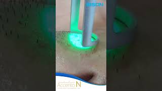 BISON MEDICAL Hair removal by using Dual Accento [upl. by Okin]