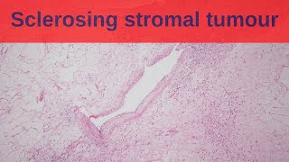 Sclerosing Stromal Tumour  Pathology mini tutorial [upl. by Brink]