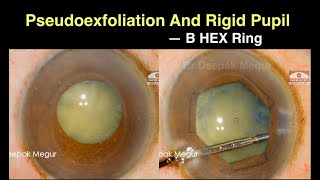 Phaco in an eye with Non Dilating Rigid pupil Pupil using B Hex ring Dr Deepak Megur [upl. by Macilroy180]