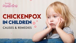 Chickenpox In Children  Causes Signs amp Treatment [upl. by Joost913]