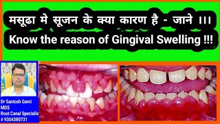 मसूढा में सूजन के कारण को जाने ।। Know the Reason of Gingival Enlagement [upl. by Arola14]