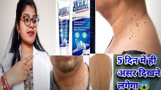 Wart Remover Ointment Honest Review2024Wart Remover ointment best usesampside effects review inhindi [upl. by Anselmi232]