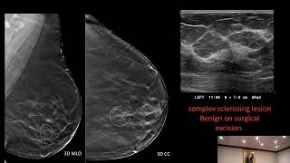 Nonmass findings on Breast Ultrasound Definitions discussions classifications and etiologies [upl. by Antonetta]