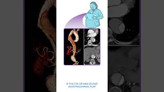 Diagnostics on Demand Aortic dissection [upl. by Jourdan]