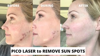 Pico Laser Treatment to Remove Sun Spots Before and After  With Dr Stefani Kappel MD EP039 [upl. by Margarita560]