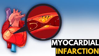 Myocardial Infarction Causes Signs and Symptoms Diagnosis and Treatment [upl. by Tamsky446]