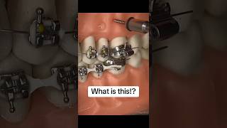 What are TADs for braces patients braces bracestips tads orthodontics dental orthodontist [upl. by Newg]