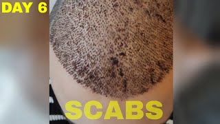 Hair Transplant Results DAY 6 FUE Turkey [upl. by Braca]