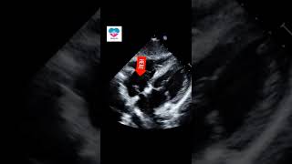 Eustachian valve in RA echocardiography heart normal variant rigth atrium [upl. by Mulvihill93]