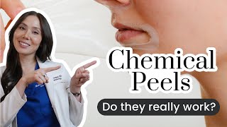 The Dos amp Donts of Chemical Peels [upl. by Cinelli259]