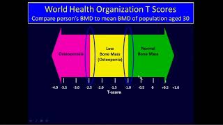 Premenopausal Osteoporosis Pathogenesis and Management [upl. by Alita]