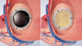 Mitralklappeninsuffizienz OP  Medizinische Animation [upl. by Naira]