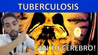 TUBERCULOSIS CEREBRAL Qué es Síntomas Diagnóstico Tratamiento Todo lo que debes saber Claro [upl. by Anyt]