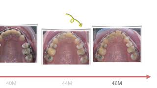 Class II Treatment with U1 Ankylosis｜【Chris Chang Ortho】CC755 [upl. by Rianon644]