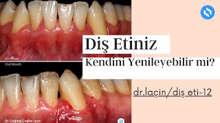 Diş Eti Kendini Onarabilir mi Yenileyebilir mi   Dr Laçin  Diş Eti 12 [upl. by Annabel]