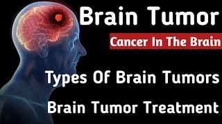 Benign Brain Tumor Brain Cancer Brain Tumor Symptoms Types of brain tumors Brain Tumor Treatment [upl. by Alard]