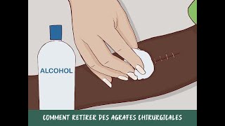 Comment retirer des agrafes chirurgicales [upl. by Cohbath649]