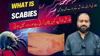 Scabies in Urdu  Kharish Ka ilaj  Skin allergy ka ilaj  Skin itching [upl. by Norm278]