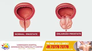 Understanding Frequent Micturition Dr Somashekar  Vamshodaya Hospitals [upl. by Seleta]