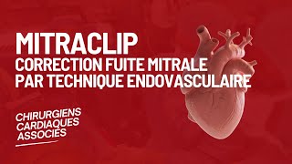 Mitraclip  Correction fuite mitrale par technique endovasculaire [upl. by Schell]