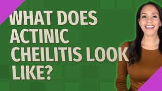 What does actinic cheilitis look like [upl. by Rogozen]