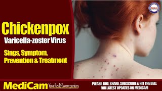 Chickenpox Signs Symptoms Prevention And Treatment [upl. by Lean]