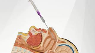 The SphenoCath® Procedure [upl. by Redwine]