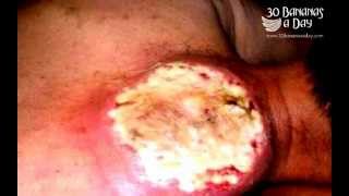 WORLDS BIGGEST ZIT CYST  Possible causes [upl. by Adachi]