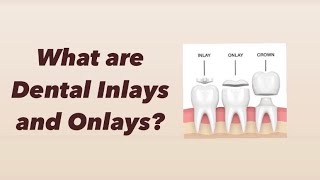 What are Dental Inlays and Onlays [upl. by Erikson]