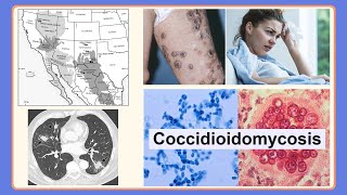 coccidioidomycosis [upl. by Erleena]