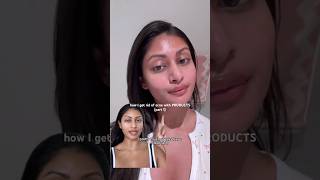 How I Get Rid Of Acne With Products Part 1 [upl. by Olpe158]