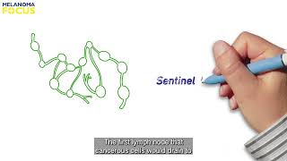 Understanding Sentinel Lymph Node Biopsy  1 of 2 [upl. by Ahsiekahs]