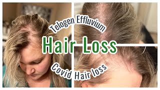 MY HAIR LOSS EXPERIENCE  TELOGEN EFFLUVIUM [upl. by Lrae957]