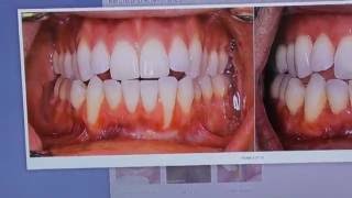 Gum Recession amp Orthodontics Theyre Connected [upl. by Osner]