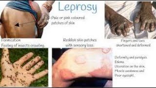 Leprosy  leprosy treatment  Leprosy pathology  hensens disease  leprosy disease [upl. by Akinehs808]