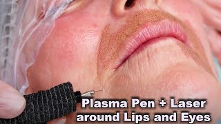 Plasma Pen Fibroblast treatment in combination with Laser for wrinkles around lips and eyelids [upl. by Illa165]