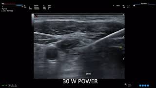 Radiofrequency Ablation of Recurrent Metastatic Papillary Thyroid Cancer to a Lymph Node [upl. by Tartan104]