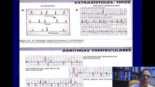 ELECTROCARDIOGRAFIA CURSO TALLER PARTE 4 TAQUIARRITMIAS 2wmv [upl. by Genisia806]