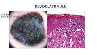 Nodular melanoma  Dr Ketty Peris [upl. by Aketahs]