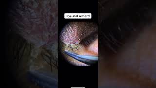 Stye Scab Removal [upl. by Inimak]