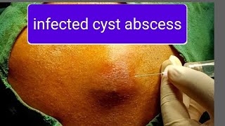 large abscess over back  incision n drainage  doctor youtube dr [upl. by Atikcir]