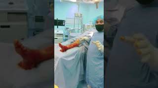 حالة مفصل شاركوت قدم سكرية Diabetic foot Charcot Joint [upl. by Anella18]