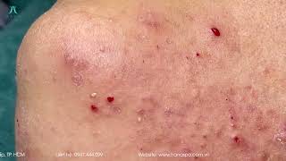 Big Cystic Acne Blackheads Extraction Blackheads amp Milia Whiteheads Removal Pimple Popping [upl. by Kcajyllib698]