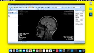 MicroDicom DICOM Viewer on macOS Sequoia using Wine [upl. by Niamjneb321]