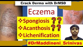 ECZEMA  DERMATITIS  Spongiosis  Acanthosis  Itching  Lichenification  Oozy  Vesicles  Crust [upl. by Egwin]