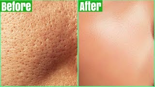 How To Get Rid Of LARGE PORES PERMANENTLY 100 Works Shrink amp Get Clear Glass Skin Naturally [upl. by Kauslick]