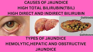 CAUSES OF JAUNDICECAUSES OF HIGH TOTAL BILIRUBINWHY IS MY DIRECT AND INDIRECT BILIRUBIN HIGH [upl. by Akinyt760]