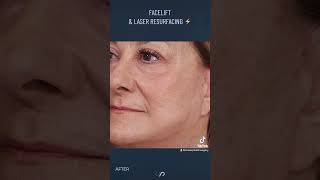 Unveiling the Magic of Facelift and Laser Resurfacing  Watch our Before and After Video [upl. by Holder145]